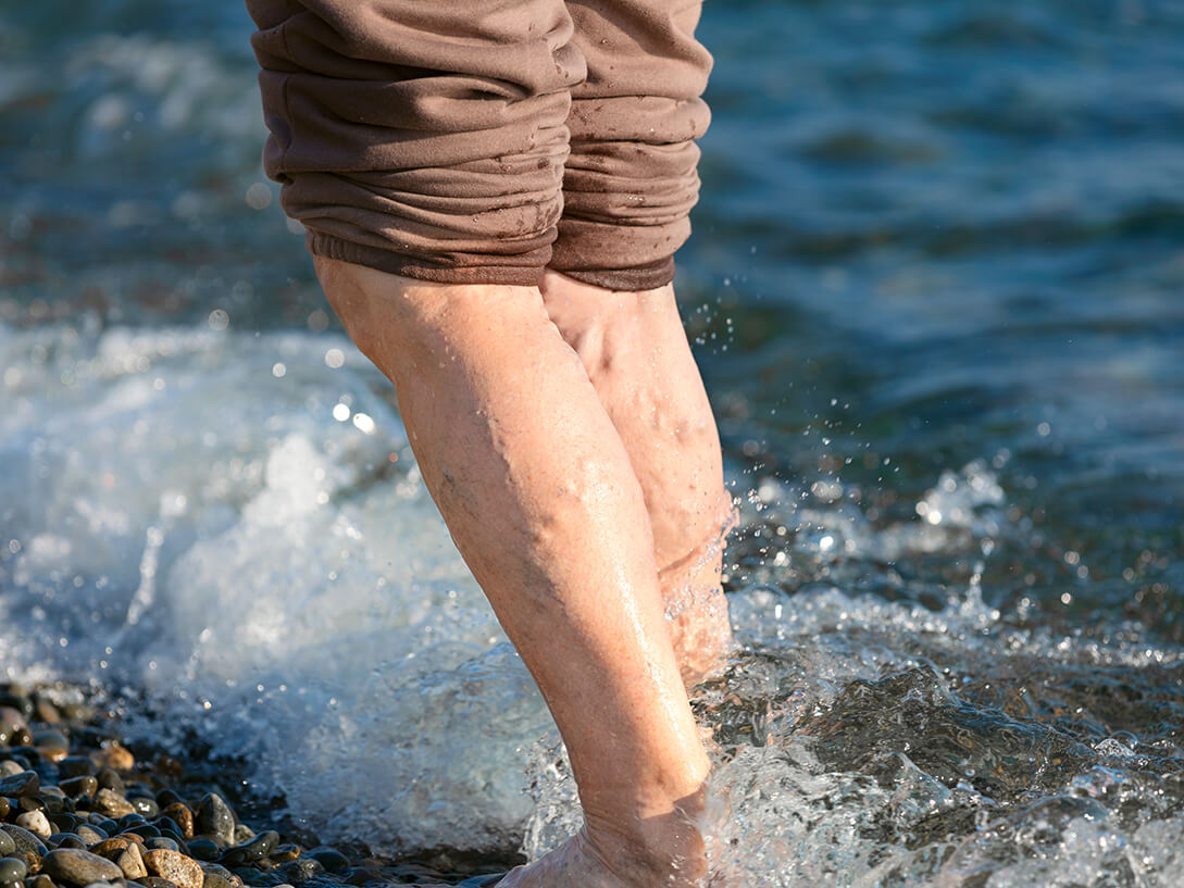 Varicose veins diagnosis & treatment - Wisconsin vein clinic