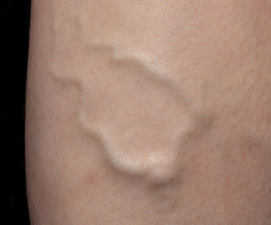 Vein treatment in office