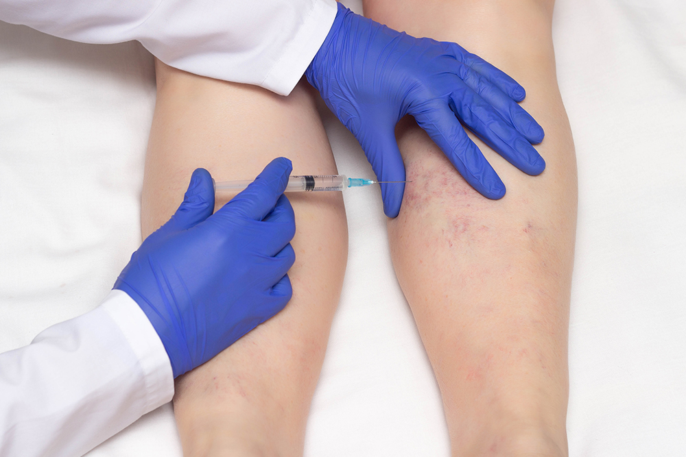 Injections (Sclerotherapy)